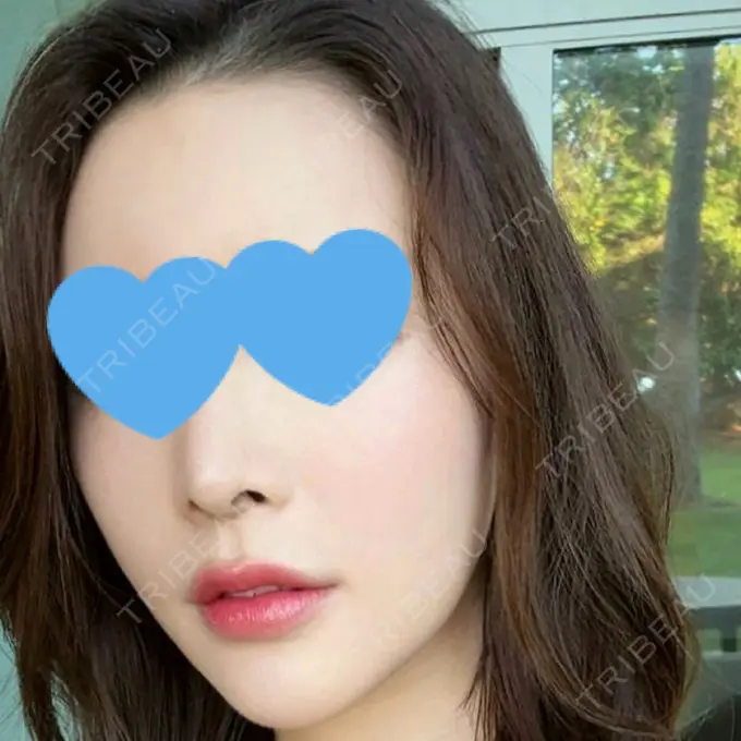 ハイフ（顔） / ミラノリピール 表参道メディカルクリニック 福岡天神院 AFTER メイン用