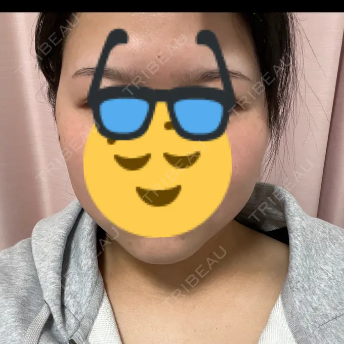 RF（高周波）たるみ治療 RIVER CLINIC（リバークリニック） DAY 25 メイン用