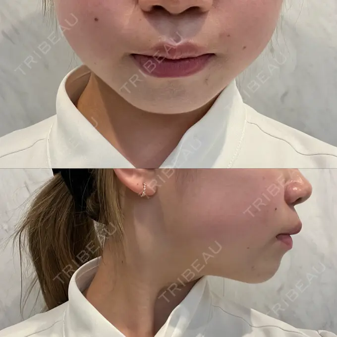 RF（高周波）たるみ治療 大美会クリニック 梅田院 DAY 5 メイン用