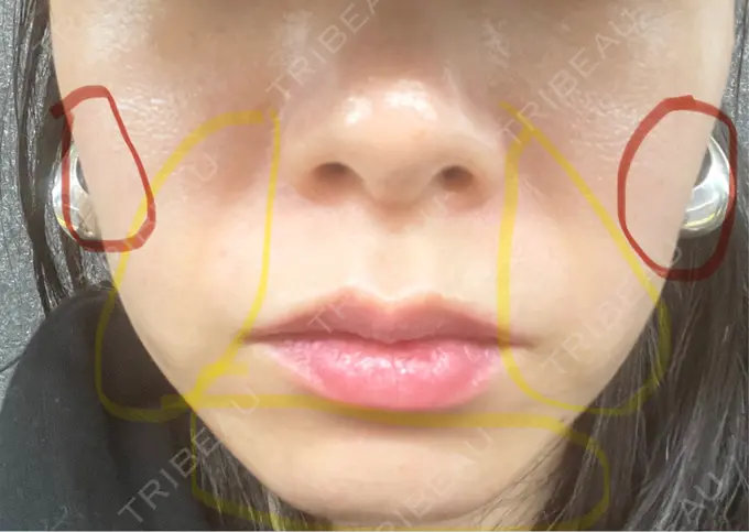 その他（輪郭） ライブリークリニック 浜松町院 AFTER メイン用