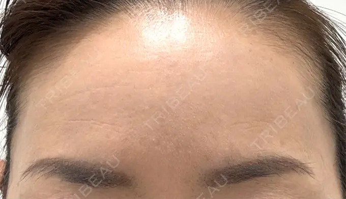 ボトックス（額） veary clinic AFTER メイン用