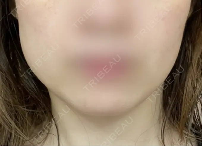 ボトックス（エラ・小顔） 形成外科と美容外科のクリニック池袋 DAY 5 メイン用