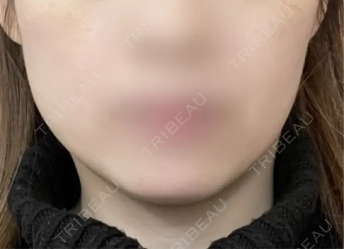 ボトックス（エラ・小顔） 形成外科と美容外科のクリニック池袋 AFTER メイン用