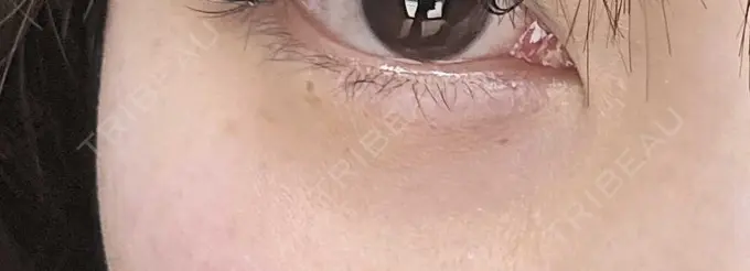 ヒアルロン酸溶解 しのぶ皮膚科 DAY 8 メイン用