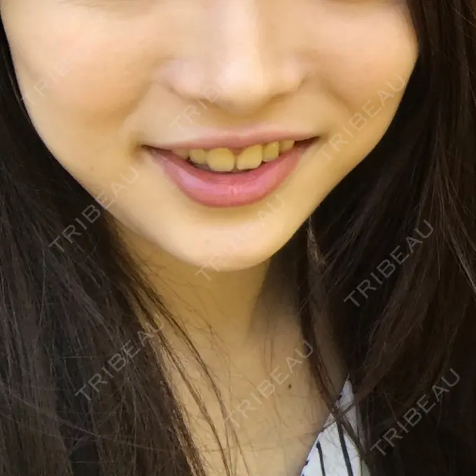 脂肪溶解注射（顔） S Beauty Clinic AFTER メイン用