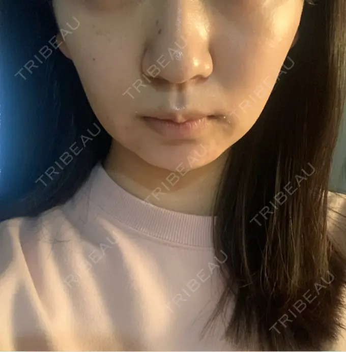 ボトックス（エラ・小顔） AYANAフィラーズクリニック 渋谷院 DAY 4 メイン用