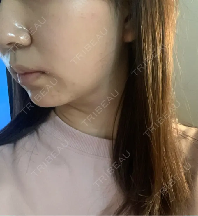 ボトックス（エラ・小顔） AYANAフィラーズクリニック 渋谷院 DAY 4 メイン用