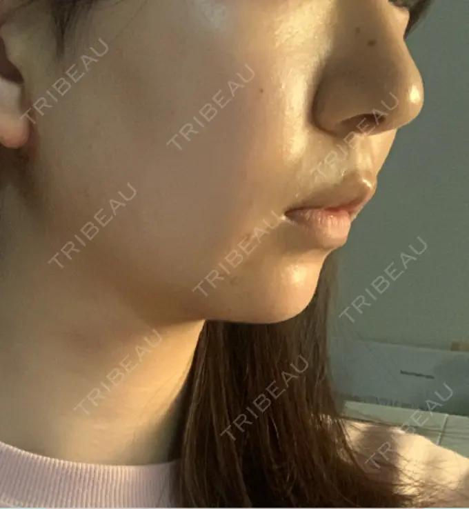 ボトックス（エラ・小顔） AYANAフィラーズクリニック 渋谷院 DAY 4 メイン用