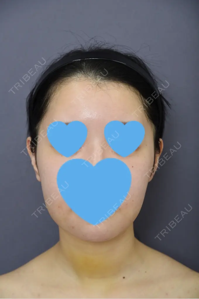 骨切り（あご） / 脂肪吸引（二の腕） 札幌ル・トロワ ビューティクリニックVogue DAY 7 メイン用