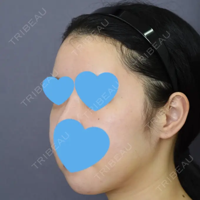 骨切り（あご） / 脂肪吸引（二の腕） 札幌ル・トロワ ビューティクリニックVogue DAY 7 メイン用