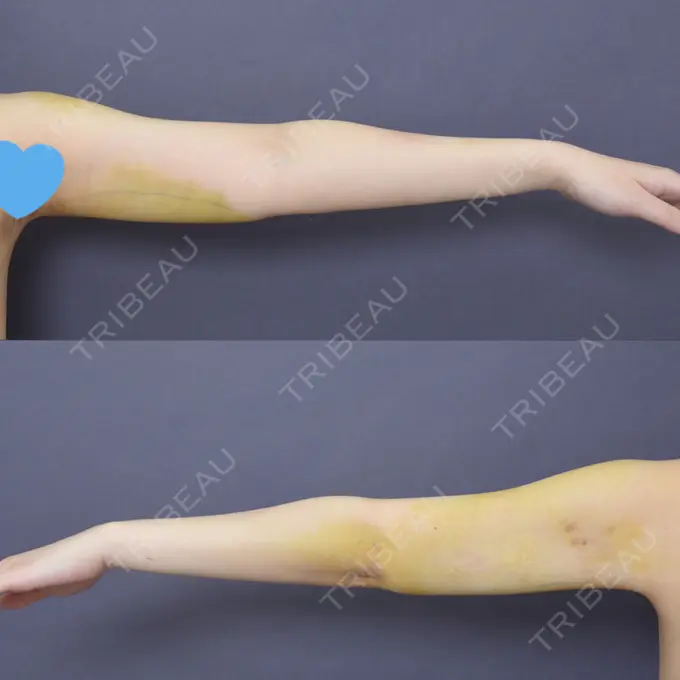 骨切り（あご） / 脂肪吸引（二の腕） 札幌ル・トロワ ビューティクリニックVogue DAY 7 メイン用