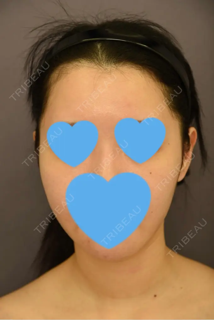 骨切り（あご） / 脂肪吸引（二の腕） 札幌ル・トロワ ビューティクリニックVogue AFTER メイン用