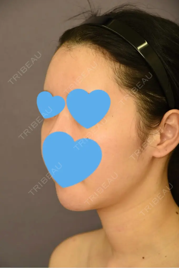 骨切り（あご） / 脂肪吸引（二の腕） 札幌ル・トロワ ビューティクリニックVogue DAY 41 メイン用