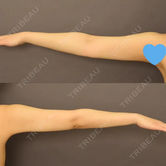 骨切り（あご） / 脂肪吸引（二の腕） 札幌ル・トロワ ビューティクリニックVogue DAY 41 メイン用