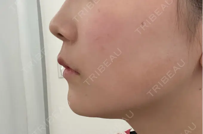 ボトックス（エラ・小顔） 大美会クリニック 岡山院 DAY 5 メイン用