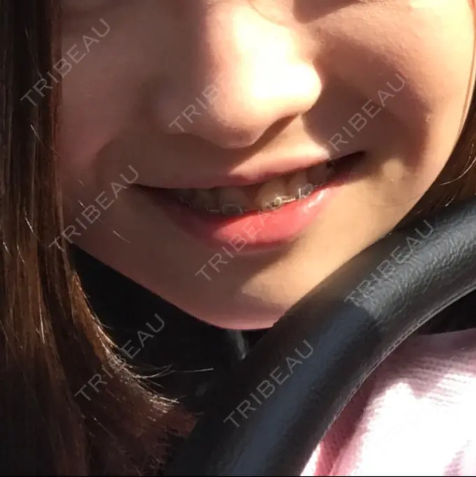 脂肪溶解注射（顔） S Beauty Clinic DAY 82 メイン用