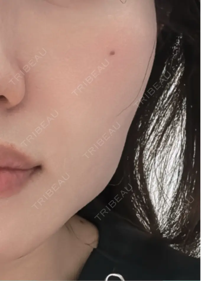 ダーマペン 新宿美容外科クリニック 立川院 AFTER メイン用