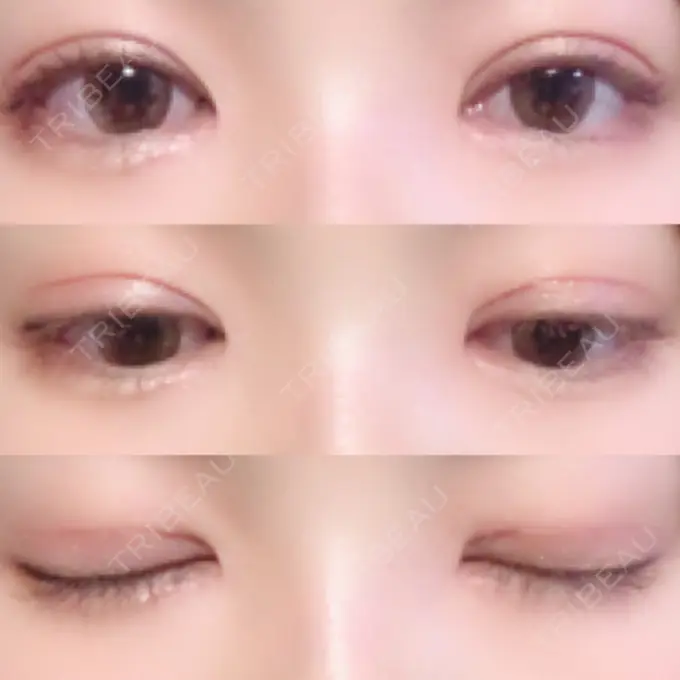 二重切開 / 目頭切開 / 眼瞼下垂（切開） / 上まぶたの脂肪取り / その他（目元） レアート整形外科 DAY 62 メイン用