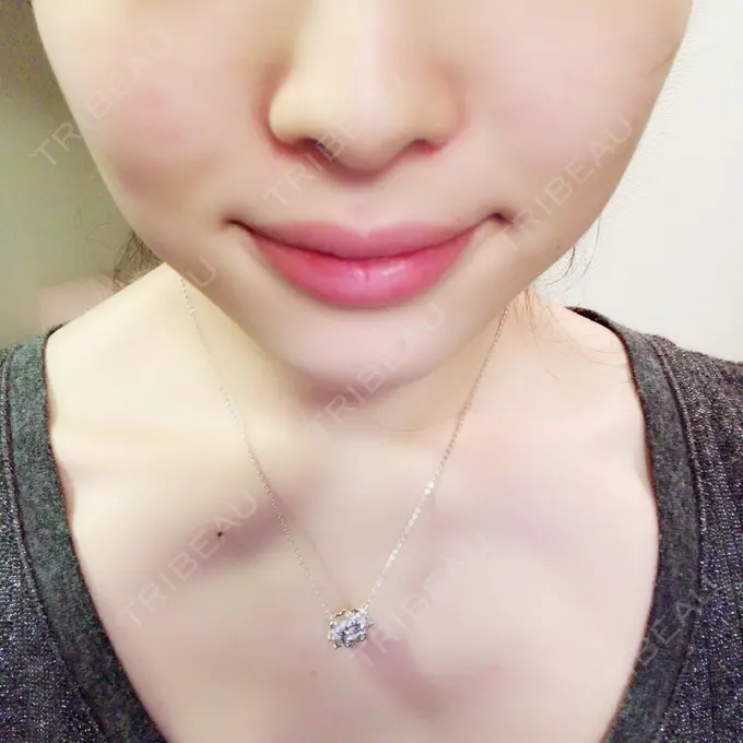 脂肪溶解注射（顔） S Beauty Clinic DAY 82 メイン用