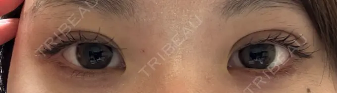 二重埋没 / 自然癒着法 東京シンデレラ美容外科 池袋院 DAY 28 メイン用