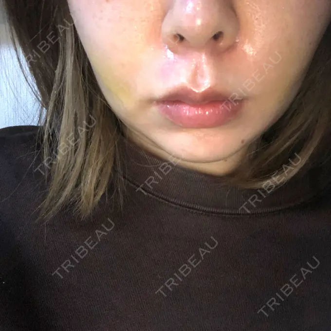 糸リフト / その他（輪郭） PRISM Beauty Clinic 町田院 DAY 6 メイン用