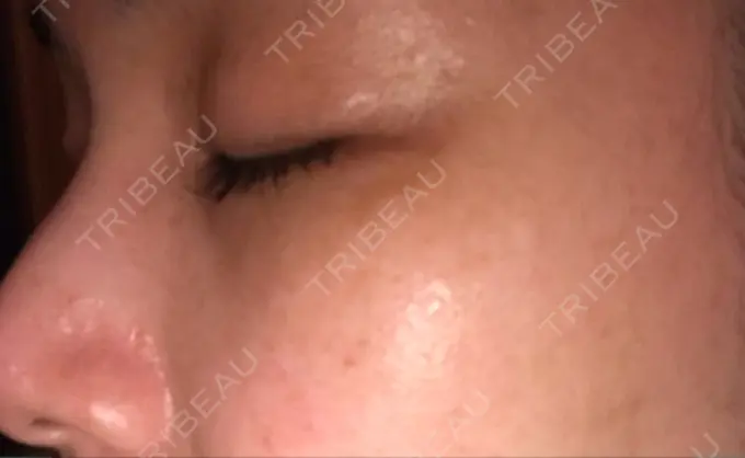 シミ取りレーザー 仁愛クリニック DAY 94 メイン用