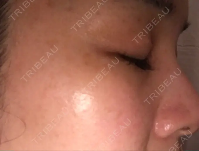 シミ取りレーザー 仁愛クリニック DAY 94 メイン用