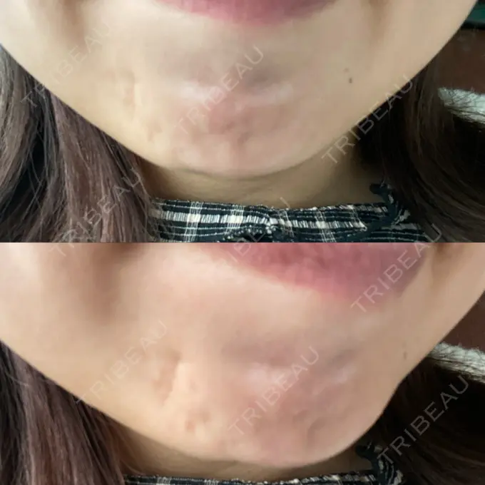 脂肪吸引注射（顔） / ボトックス（あご） / ボトックス（口角） / ボトックス（眉間） / その他（口元） TCB東京中央美容外科 静岡院 DAY 5 メイン用