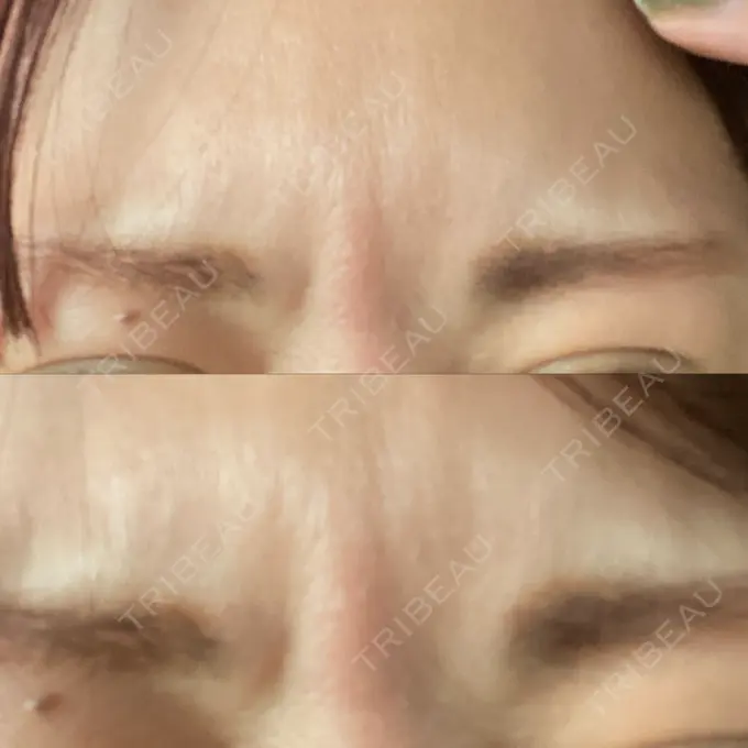 脂肪吸引注射（顔） / ボトックス（あご） / ボトックス（口角） / ボトックス（眉間） / その他（口元） TCB東京中央美容外科 静岡院 DAY 5 メイン用