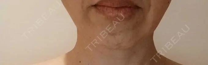 糸リフト 湘南美容クリニック 吉祥寺院 DAY 4 メイン用