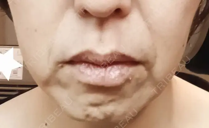 糸リフト 湘南美容クリニック 吉祥寺院 DAY 0 メイン用