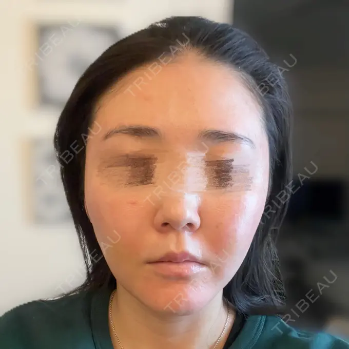 糸リフト / 脂肪吸引（顔） / メーラーファット除去 eクリニック 福岡院 DAY 7 メイン用