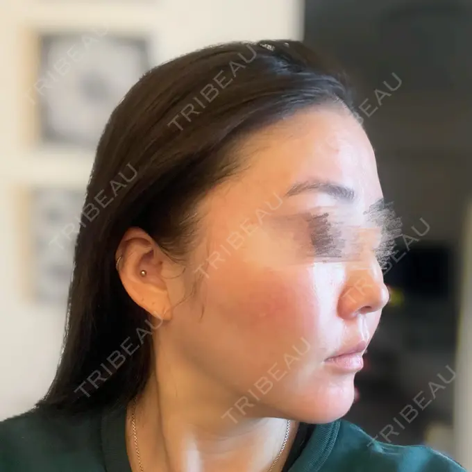 糸リフト / 脂肪吸引（顔） / メーラーファット除去 eクリニック 福岡院 DAY 7 メイン用