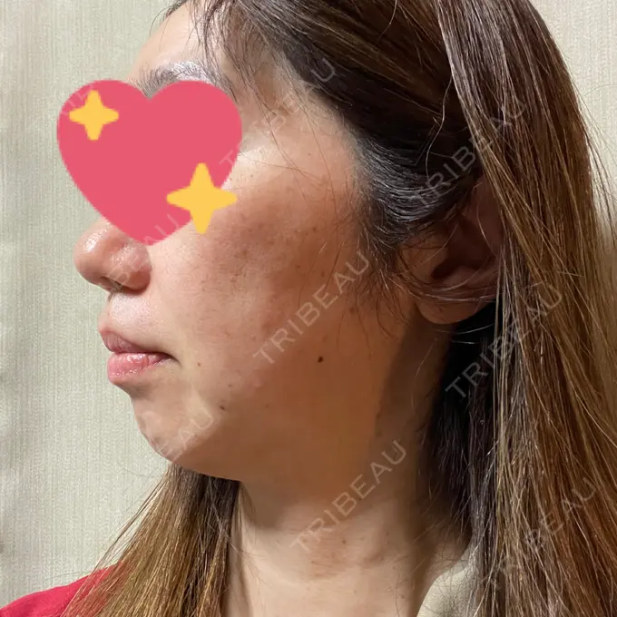 ピーリング（ハリ・ツヤ） / ルメッカ 大美会クリニック 梅田院 DAY 3 メイン用