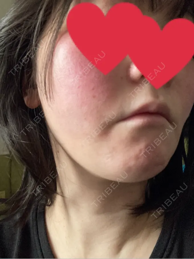 脂肪吸引（顔） / 切開リフト GRACY TOKYO CLINIC【グレイシートウキョウクリニック】 DAY 15 メイン用