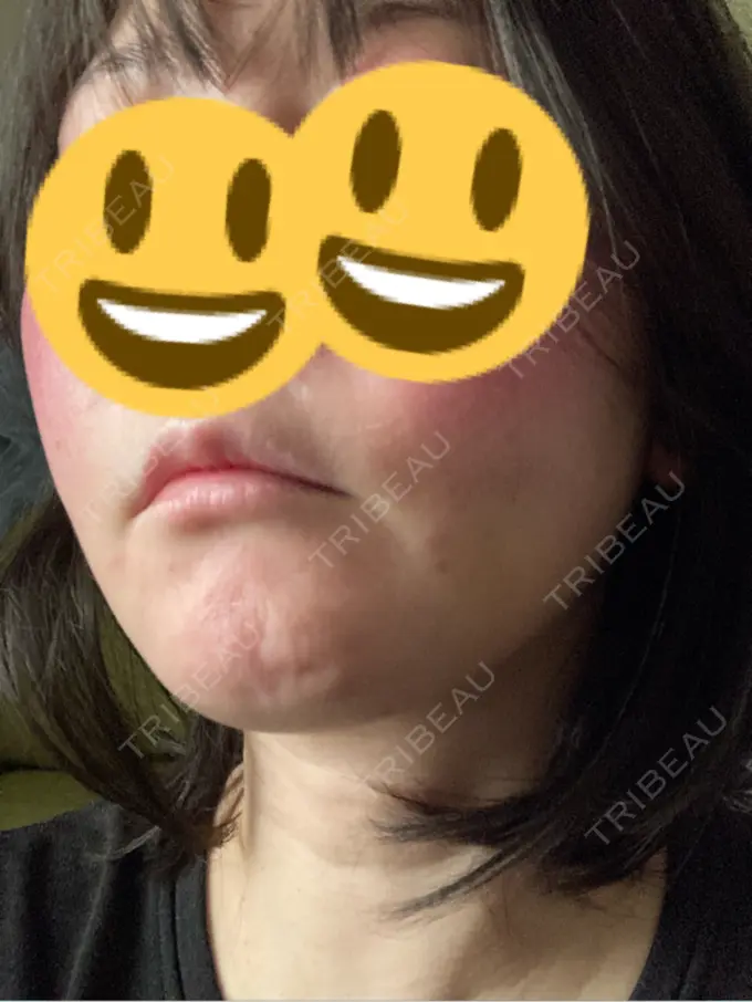 脂肪吸引（顔） / 切開リフト GRACY TOKYO CLINIC【グレイシートウキョウクリニック】 DAY 15 メイン用