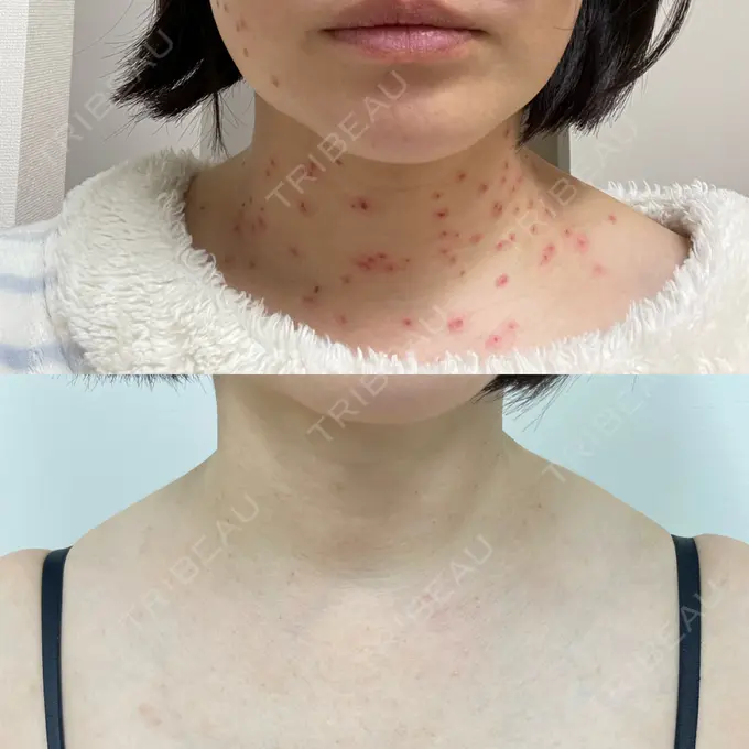 ベビーコラーゲン / シミ取りレーザー / ほくろ・いぼ除去レーザー（首） 渋谷美容外科クリニック 渋谷院 AFTER メイン用