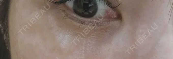 ヒアルロン酸溶解 しのぶ皮膚科 DAY 9 メイン用