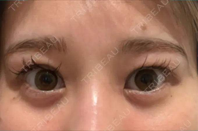 クマ治療 / 下まぶたの脂肪取り / その他（目元） ROOTS Clinic AFTER メイン用