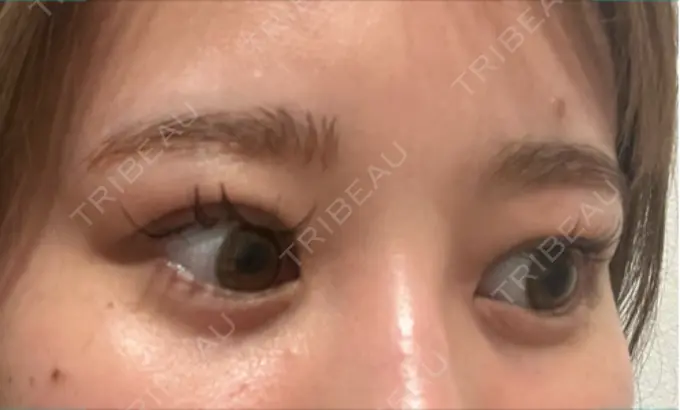 クマ治療 / 下まぶたの脂肪取り / その他（目元） ROOTS Clinic DAY 75 メイン用