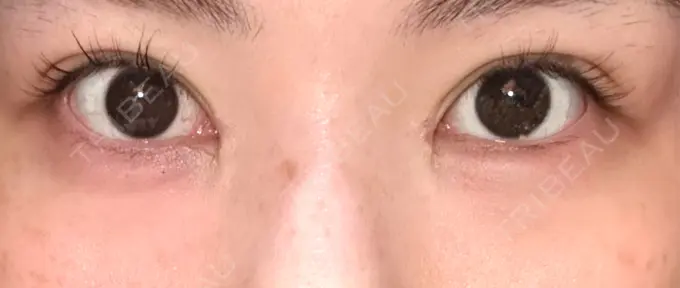 二重埋没 / 目頭切開 / その他（目元） eクリニック 福岡院 DAY 15 メイン用