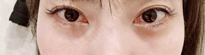 ヒアルロン酸溶解 しのぶ皮膚科 AFTER メイン用