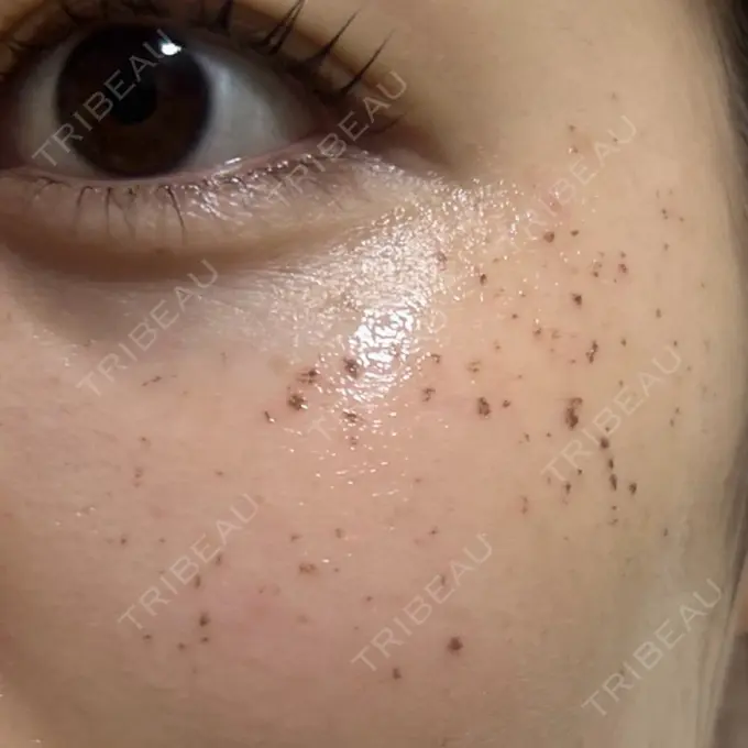 イオン導入 / ルメッカ ルラ美容クリニック 池袋院 DAY 1 メイン用