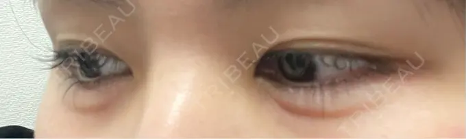 ヒアルロン酸注入（涙袋） 共立美容外科 梅田院 DAY 0 メイン用