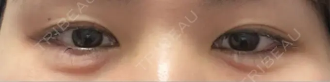 ヒアルロン酸注入（涙袋） 共立美容外科 梅田院 DAY 0 メイン用