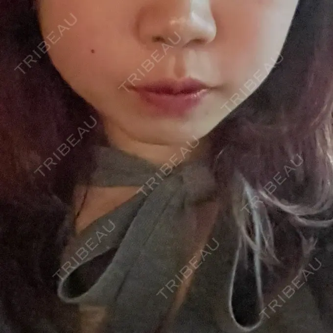 RF（高周波）たるみ治療 大美会クリニック 梅田院 DAY 8 メイン用