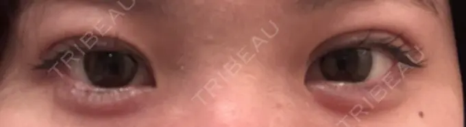 二重埋没 / 自然癒着法 東京シンデレラ美容外科 池袋院 DAY 31 メイン用