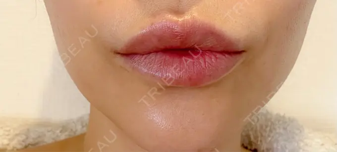 ボトックス（あご） / ヒアルロン酸注入（唇） / ボトックス（口角） / その他（口元） ルラ美容クリニック 神戸院 AFTER メイン用