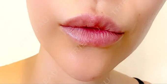 ボトックス（あご） / ヒアルロン酸注入（唇） / ボトックス（口角） / その他（口元） ルラ美容クリニック 神戸院 DAY 6 メイン用