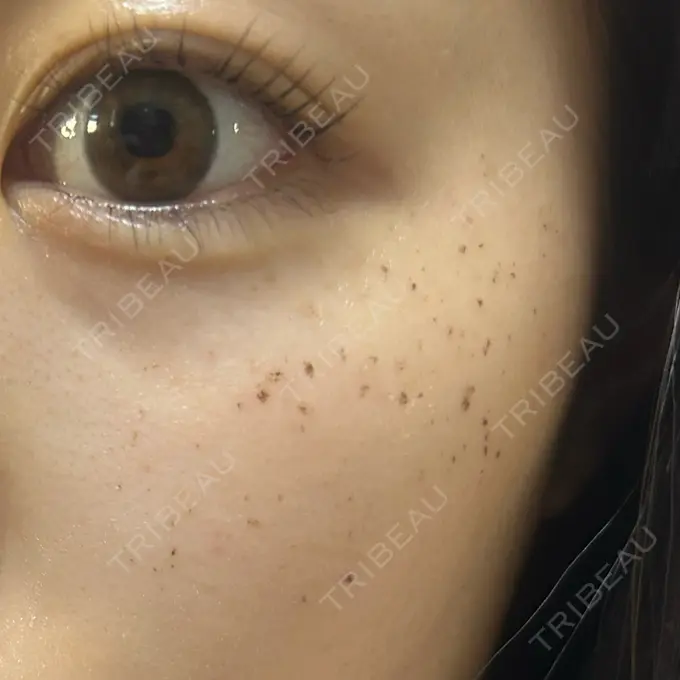 イオン導入 / ルメッカ ルラ美容クリニック 池袋院 DAY 3 メイン用